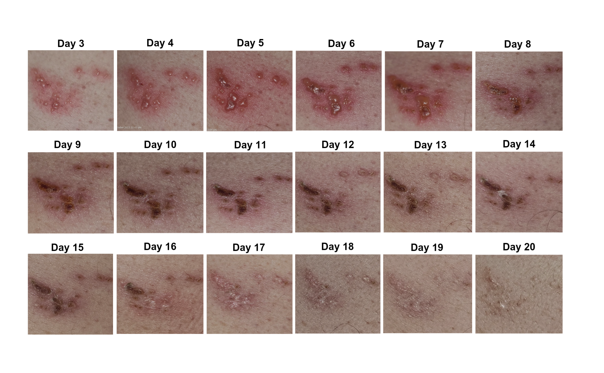 A 20 Days Visual Follow Up on Herpes Zoster (Shingles)